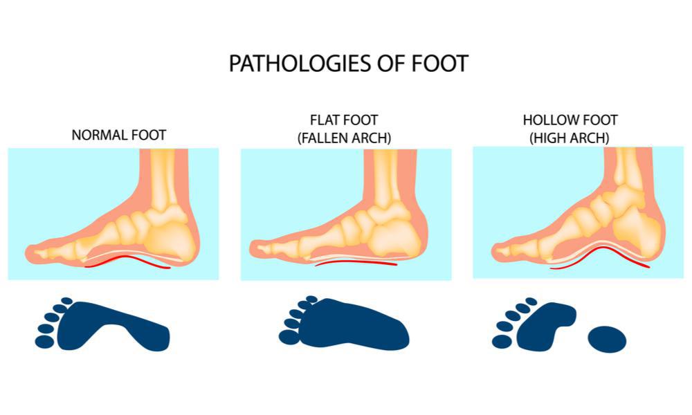 Do You Know Your Foot Type? (And Why You Should)