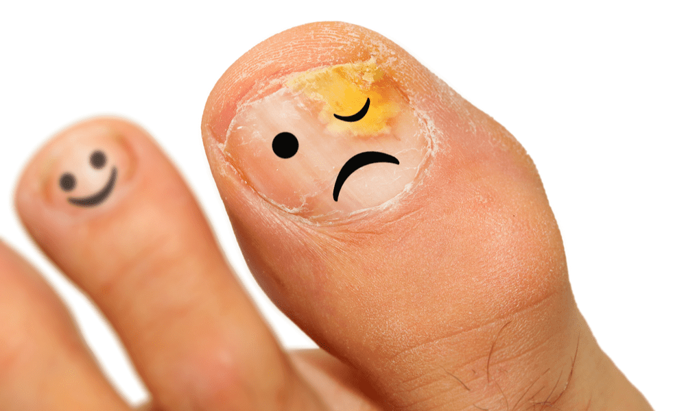 How Effective Is Laser Therapy for Toenail Fungus?