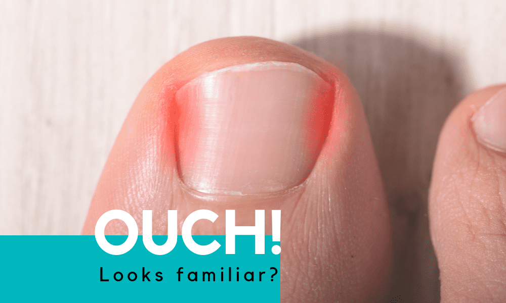 Everything You Need to Know About Ingrown Toenail Removal
