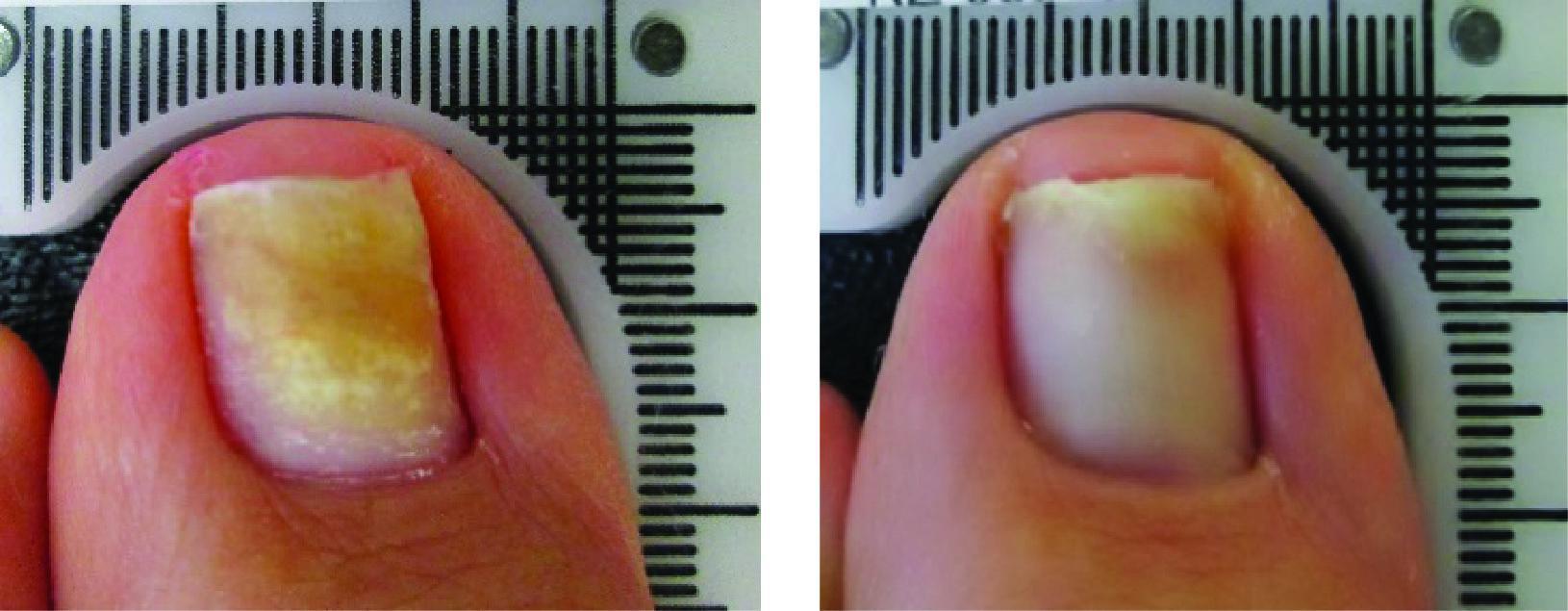 Before and After Laser Therapy For Toenail Fungus Patient 1