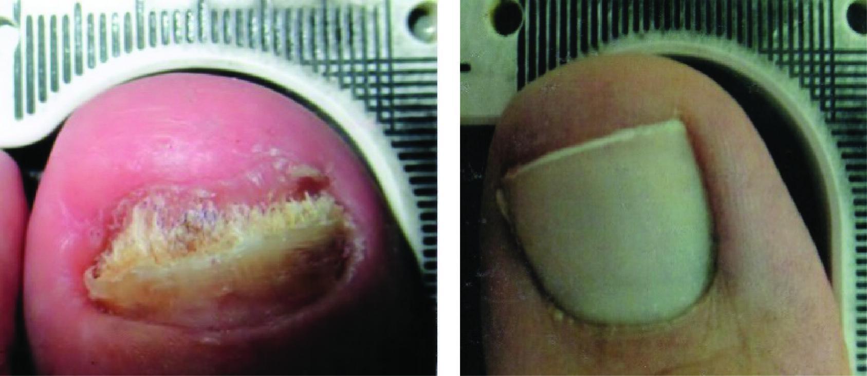 Before and After Laser Therapy For Toenail Fungus Patient 4