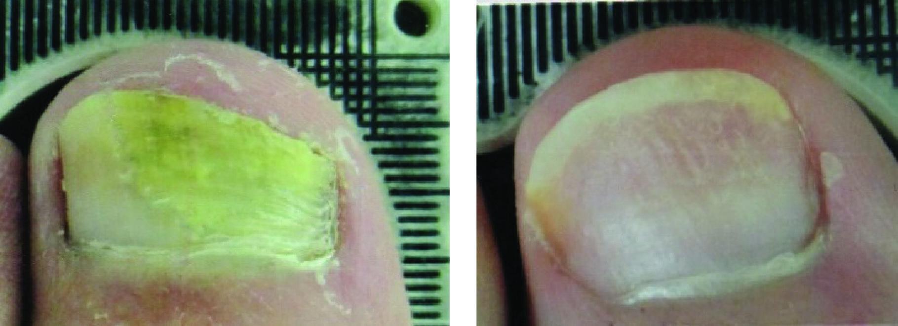 Before and After Laser Therapy For Toenail Fungus Patient 5