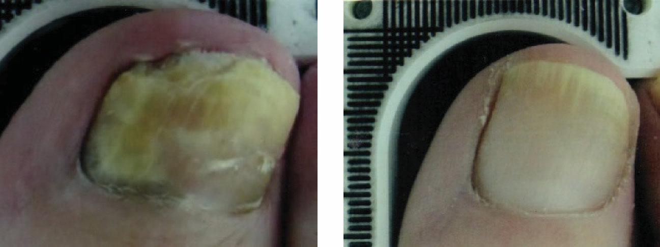 Before and After Laser Therapy For Toenail Fungus Patient 2