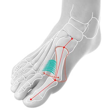Bunion, Hallux Valgus