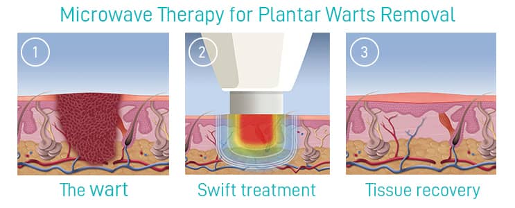 Microwave Therapy for Plantar Warts Removal