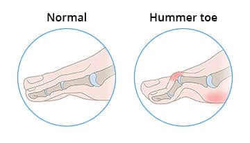 What Is a Hammer Toe?