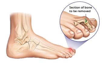 What Is Hammer Toe Surgery?