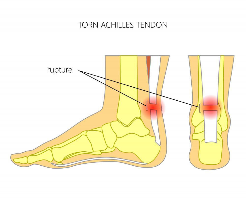 Achilles Tendonitis and Plantar Fasciitis