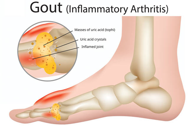 Gout Inflammatory Arthritis