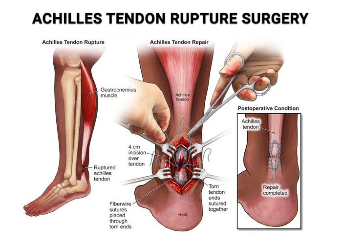 Achilles Tendon Surgery NJ