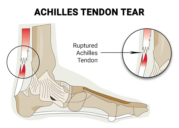 Achilles Tendon Tear