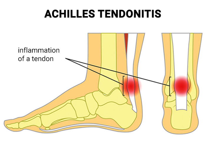 Achilles Tendonitis