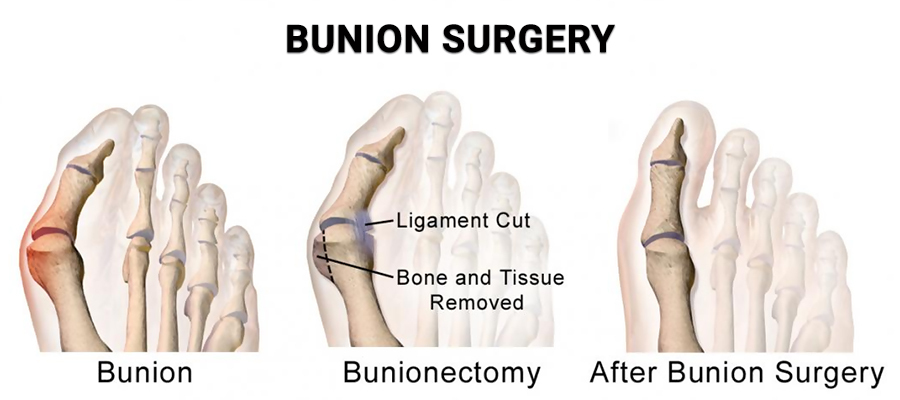 Before, Proces & After Bunionectomy Also Know Bunion Removal Surgery