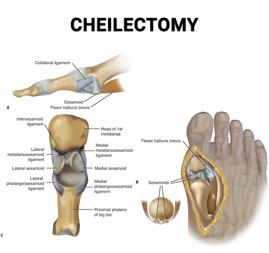 Cheilectomy NJ