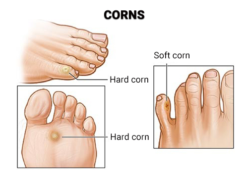 Corn Removal NJ