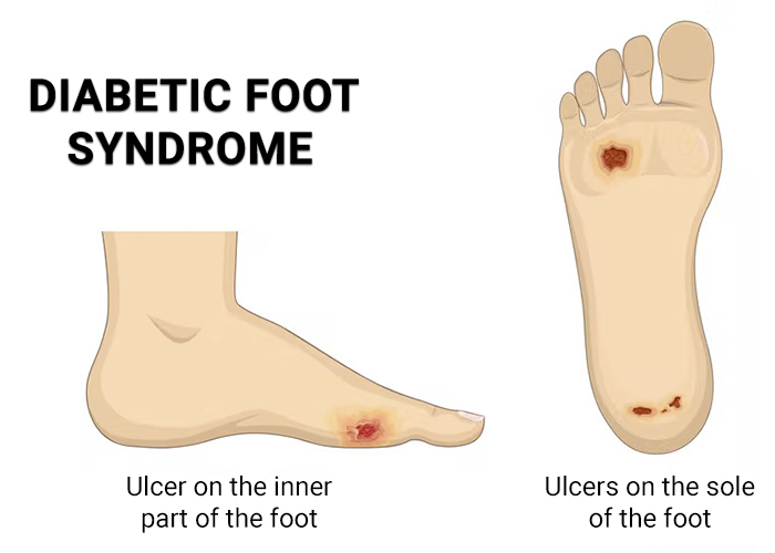 Diabetic Foot NJ