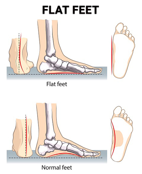 Flat Feet NJ