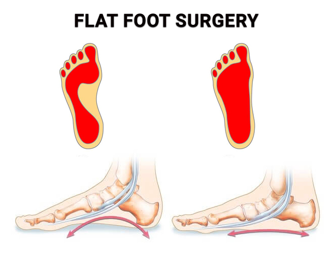 Flat Foot Surgery NJ