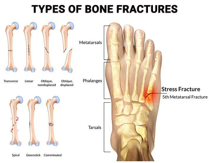 Foot Ankle Fractures NJ