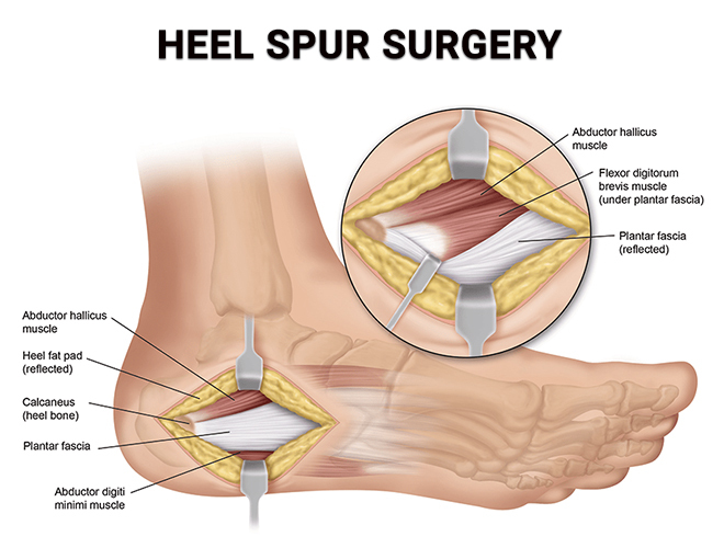 Heel Spur Surgery NJ
