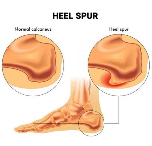Heel Spur