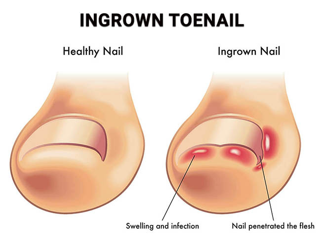 Ingrown Toenail NJ