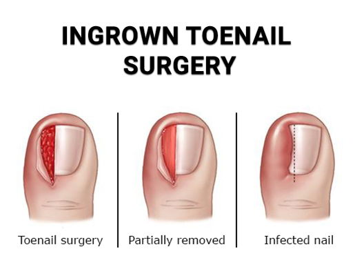 Ingrown Toenail Surgical Treatment