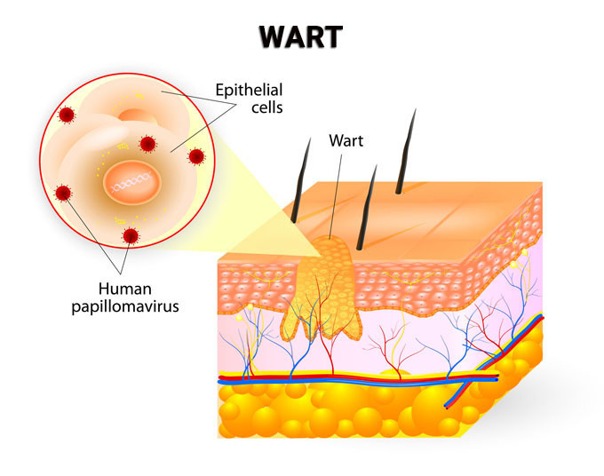 Laser Wart Removal