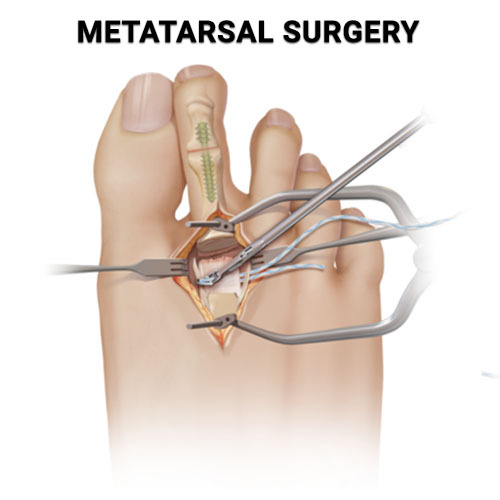 Metatarsal Surgery