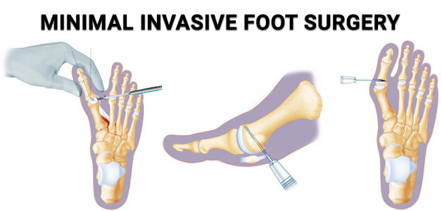 Minimal Invasive Foot Surgery