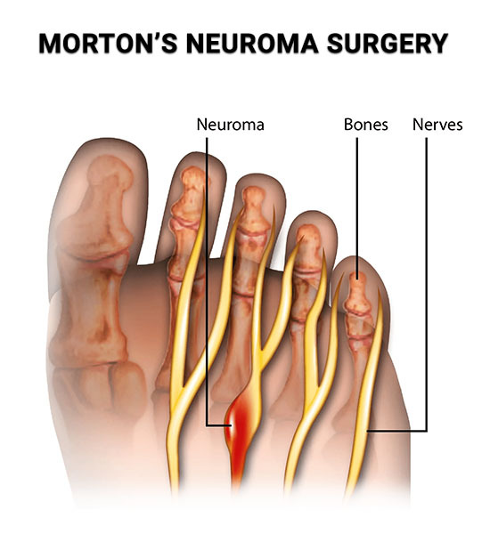 Mortons Neuroma Surgery NJ