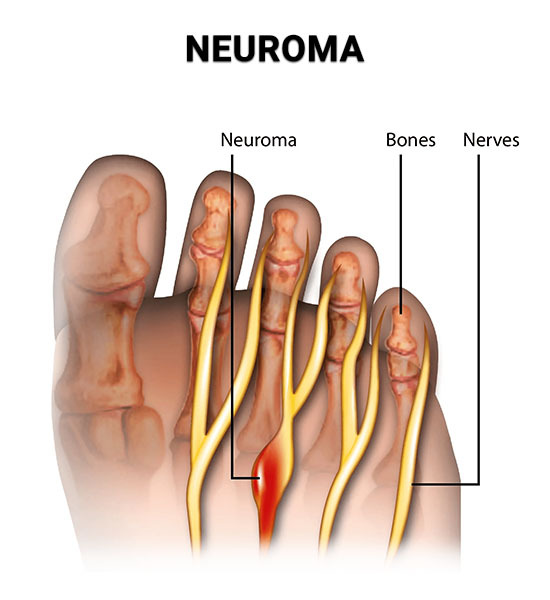 Neuroma