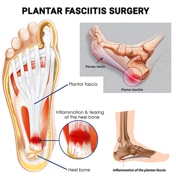 Plantar Fasciitis Surgery NJ