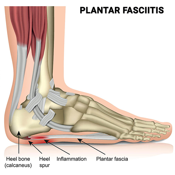 Plantar Fasciitis