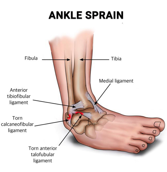 Sprained Ankle