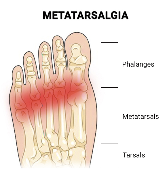 Metatarsalgia