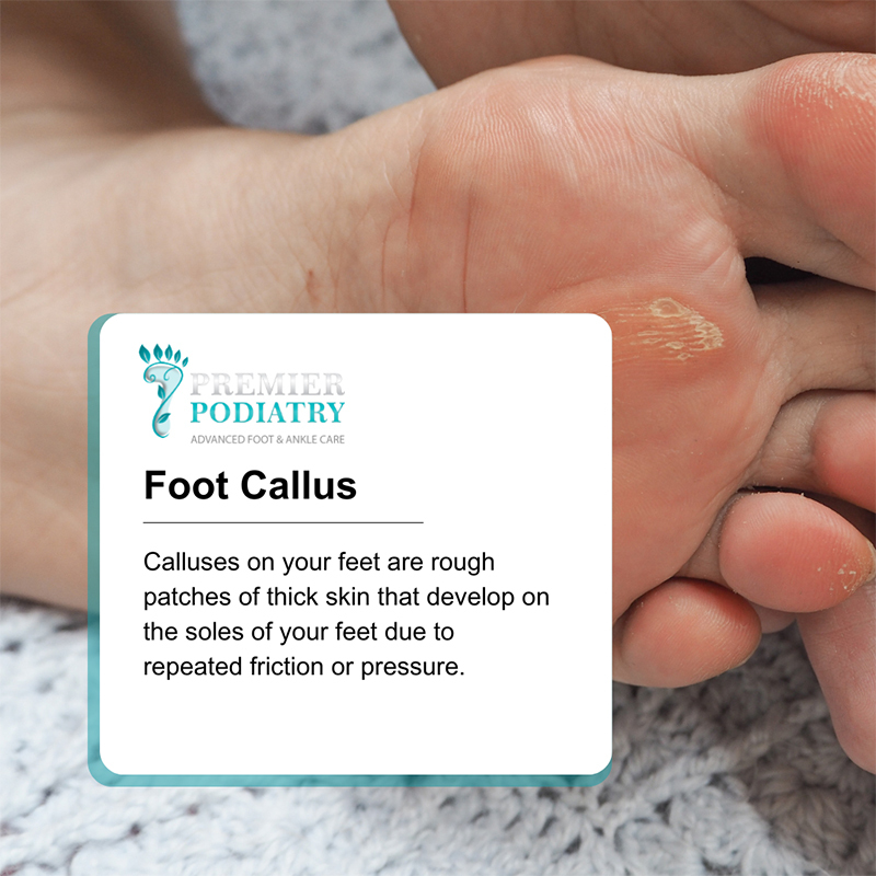 Calluses in NJ