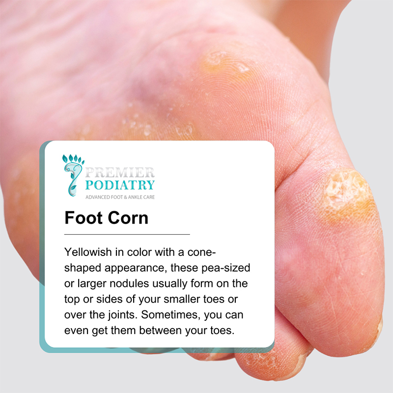Foot Corns in NJ