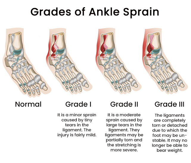 Foot Sprain