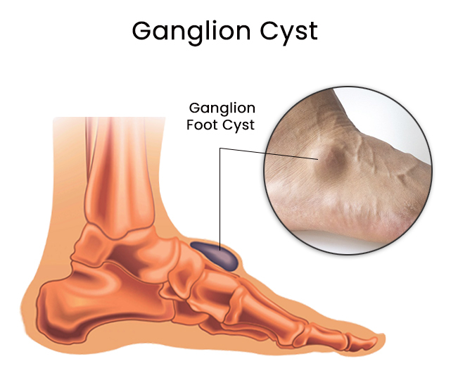 Ganglion Cysts
