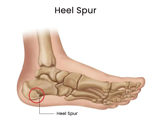 Heel Spur