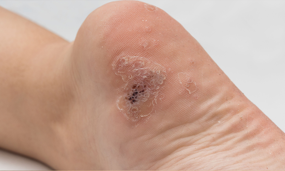 How to Get Rid of Plantar Warts for Good