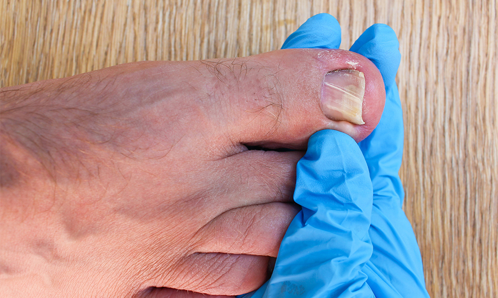 How to Remove an Ingrown Toenail