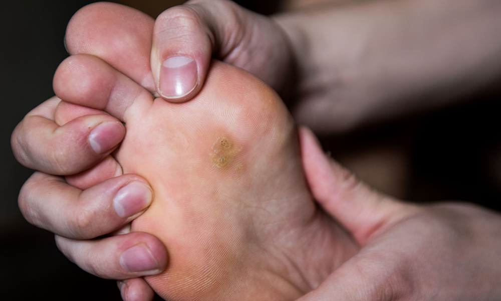 How to Safely Remove a Foot Corn at Home