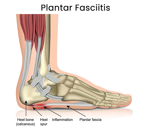 Plantar Fasciitis Anatomy