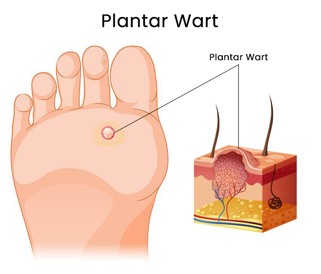 Plantar Wart