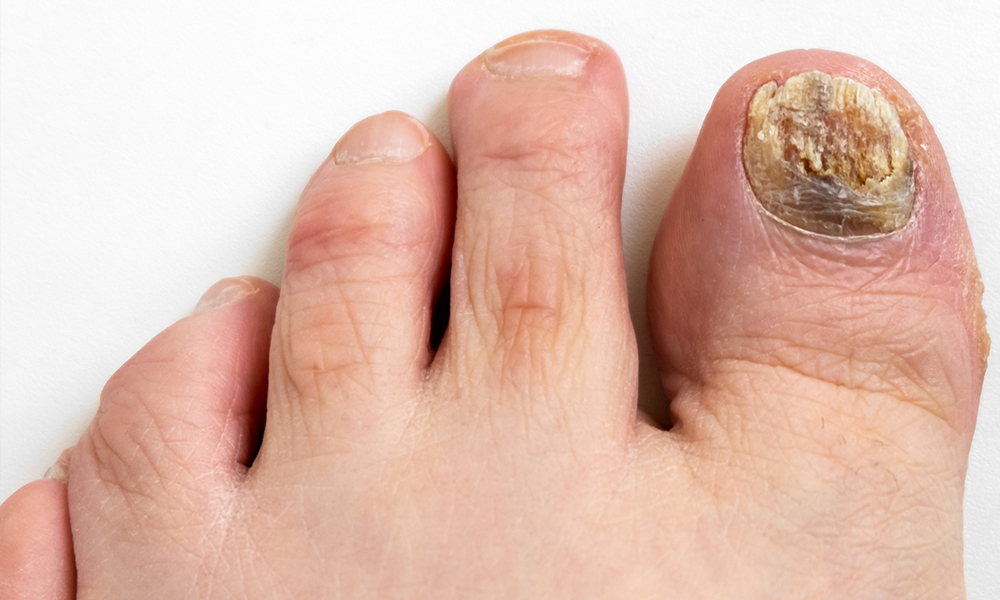 Types & Stages of Toenail Fungus