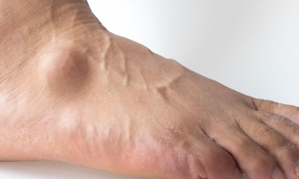 What Causes a Ganglion Cyst on Your Foot and Ankle?