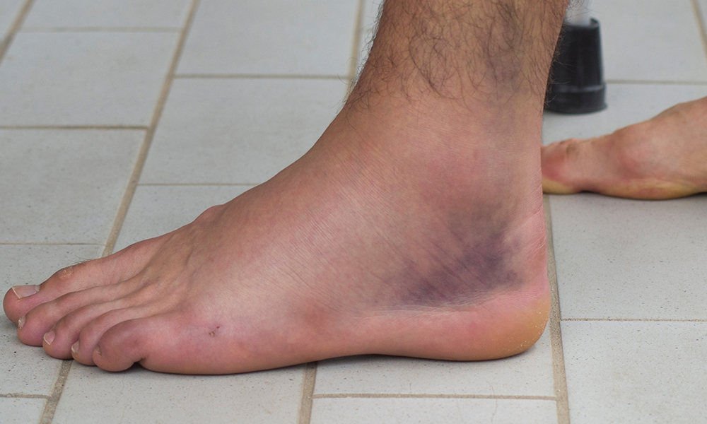 What to Know About a Foot Sprain