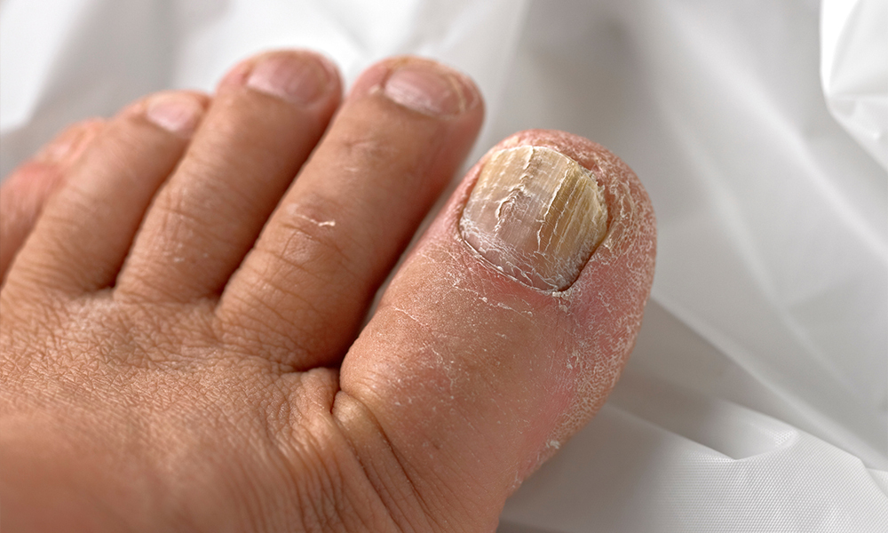 Why Is Toenail Fungus So Difficult to Treat